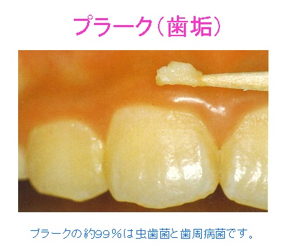 新潟市＿歯のクリーニング＿プラーク1.jpg