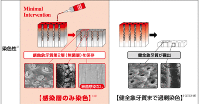 niigata_whitening_direct_bonding2.gif