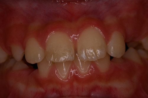niigata_whitening_direct_bonding2.JPG