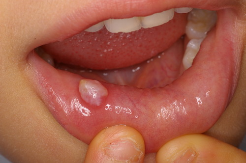 niigata_whitening_mucocele1.JPG