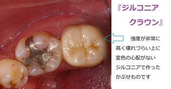 zirconia.jpg