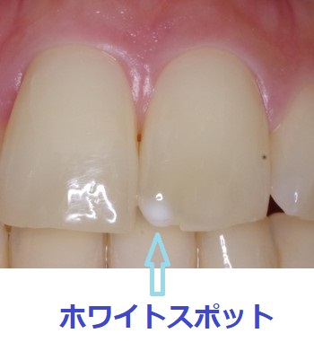 whitespot_teeth.jpgのサムネール画像