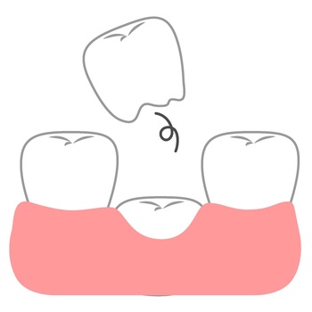 missing_teeth.jpgのサムネール画像