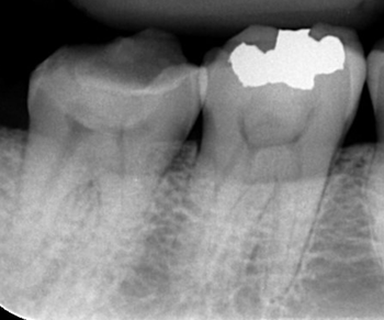 dental_caries.pngのサムネール画像