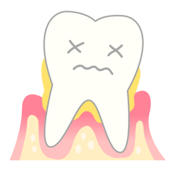 periodontosis_mechanism04.pngのサムネール画像